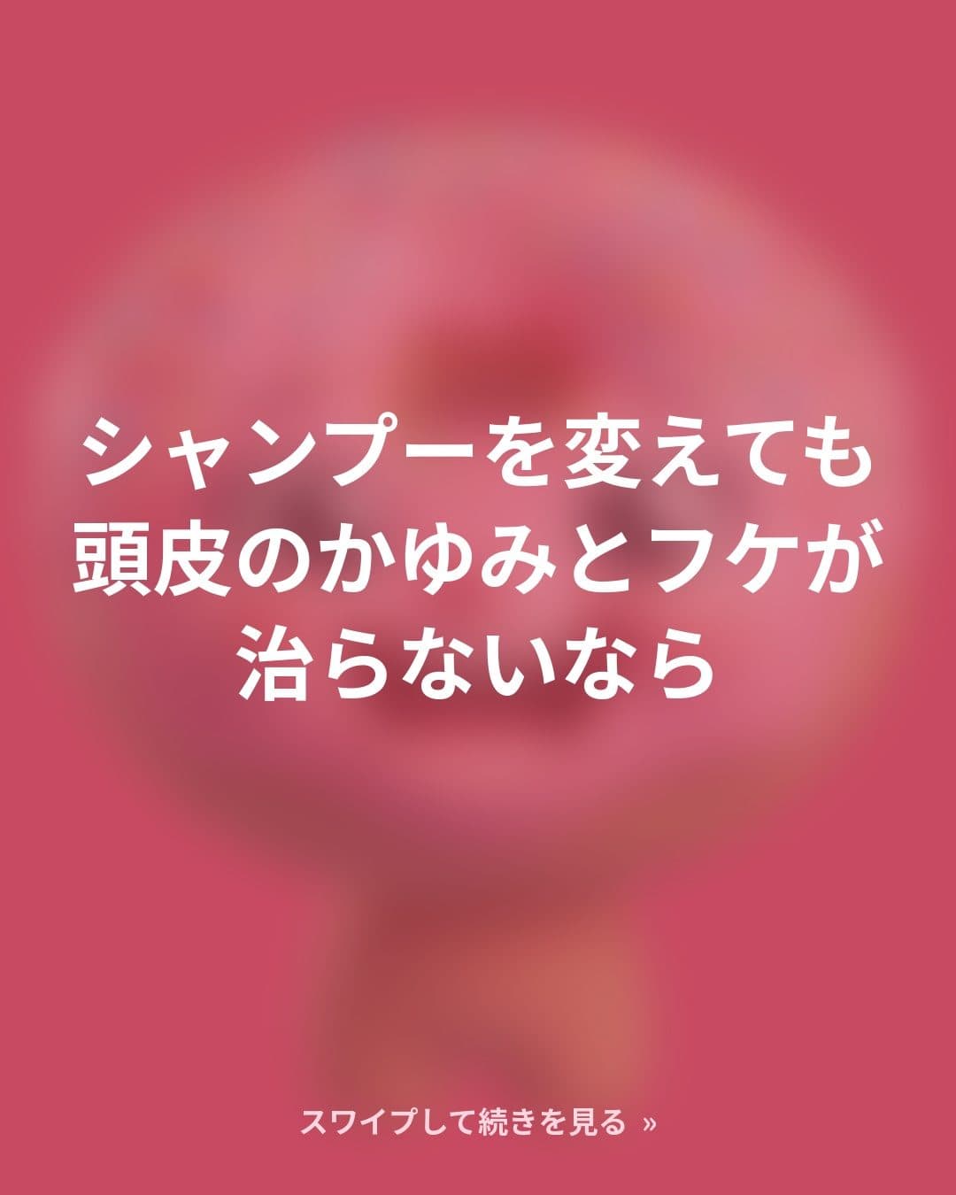 頭皮のかゆみとフケが治らないのは、シャンプーのせいじゃないかもしれません